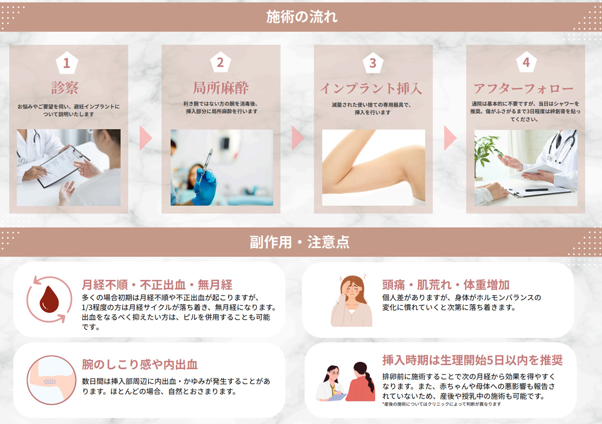 避妊インプラントについて