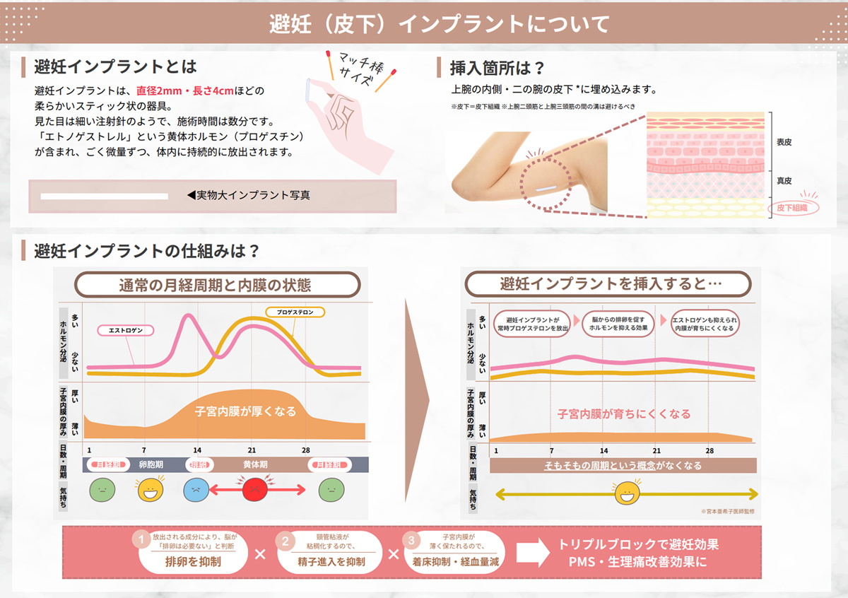 避妊インプラントについて